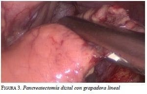 Pancreatectomía distal