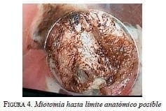 Miotomía hasta límite anatómico