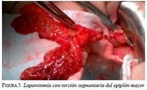 Laparotomía con torsión segmentaria