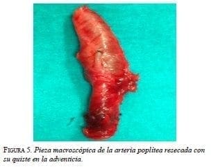 Pieza macroscópica de la arteria poplítea