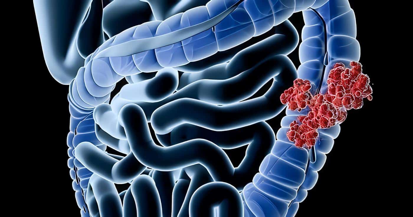 Oncología y Radioterapia, Diagnóstico de Cáncer de Colon y Recto