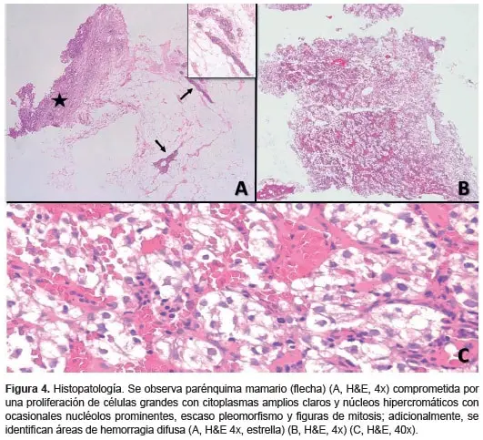 Carcinoma de células claras renales, Parénquima mamario