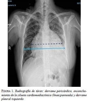 Radiografía de Tórax: Derrame Pericárdico