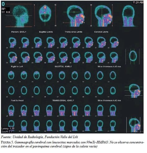 Gammagrafía Cerebral con Leucocitos
