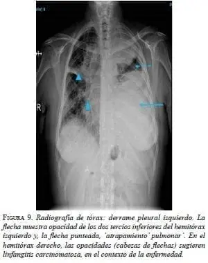 Radiografía de Tórax: Derrame Pleural