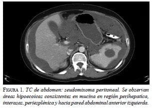 TC de Abdomen: Seudomixoma Peritoneal