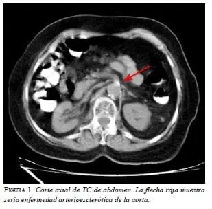 Enfermedad Arterioesclerótica de la Aorta