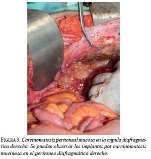 Carcinomatosis Peritoneal Mucosa