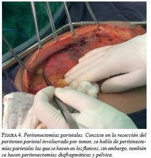 Peritonectomías Parietales