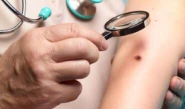 Guía clínica cáncer de piel no melanoma