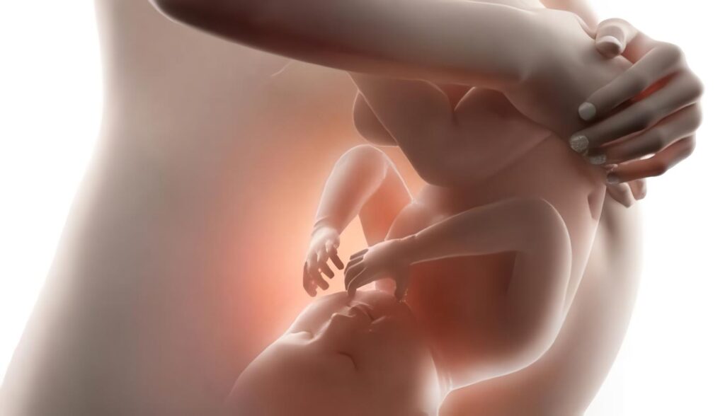 ¿Cual es La Intervención más Efectiva para El Manejo de La Hemorragia Obstétrica por Abrupcio de Placenta?