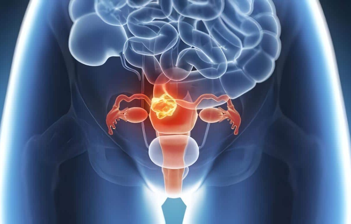 Tipo de Histerectomía Indicada para El Manejo de La Hemorragia Posparto