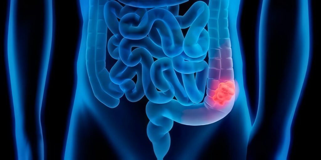 Guía Clínica para Diagnóstico de Cáncer de Colon y Recto, Seguimiento
