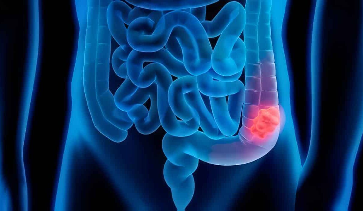 Diagnóstico de Cáncer de Colon y Recto, Seguimiento