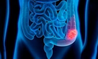 Diagnóstico de Cáncer de Colon y Recto, Seguimiento