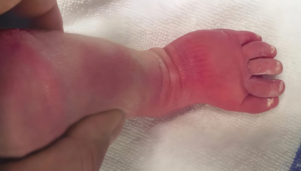 ¿Cuáles son Las Pruebas recomendadas para Establecer El Diagnostico de Infección Congénita en El Recién Nacido?