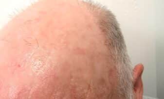 Queratosis actínica