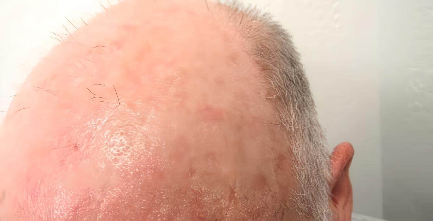 Queratosis actínica