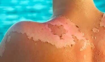 Por qué aparece el cáncer de piel