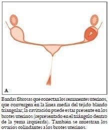 Bandas fibrosas que conectan los remanentes uterinos