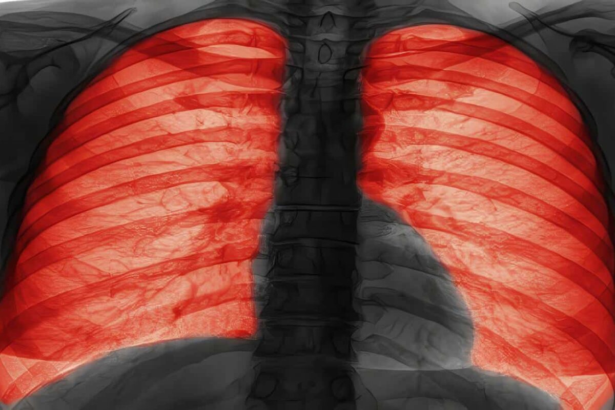 Señales de alerta a nivel pulmonar, Fibrosis Quística