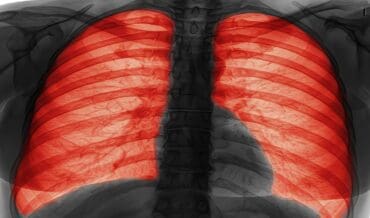 Señales de alerta a nivel pulmonar, Fibrosis Quística