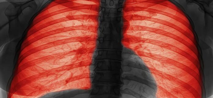 Señales de alerta a nivel pulmonar, Fibrosis Quística