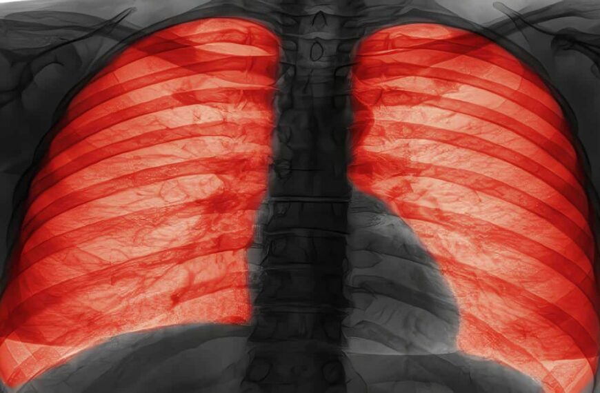 Señales de alerta a nivel pulmonar, Fibrosis Quística