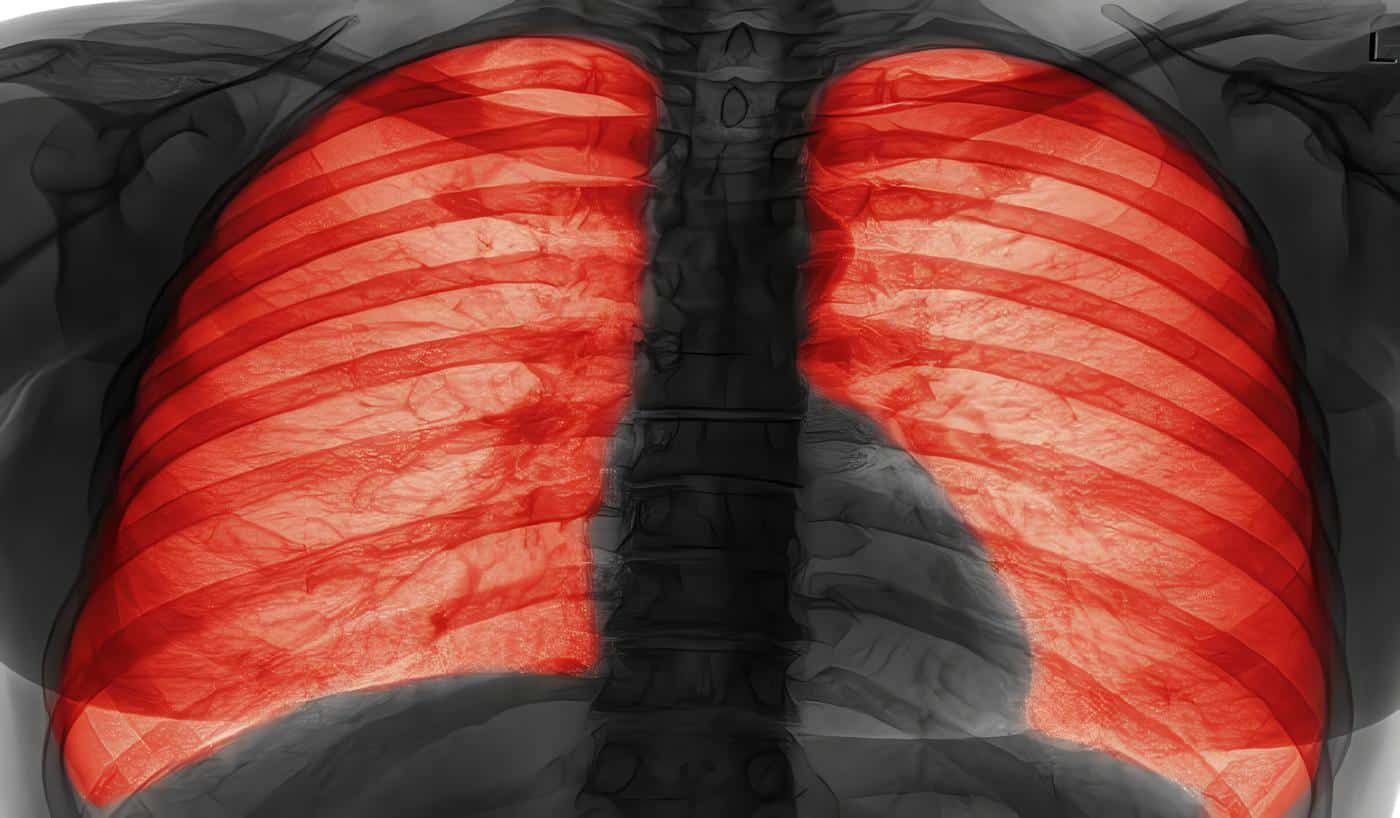 Señales de alerta a nivel pulmonar, Fibrosis Quística