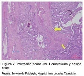Adenocarcinoma de yeyuno, Infiltración perineural