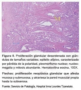 Adenocarcinoma de yeyuno, Proliferación glandular