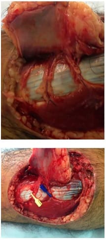 Disección y selección de la arteria perforante