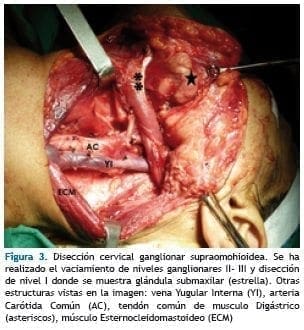 Disección cervical ganglionar supraomohioidea
