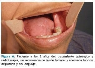 Lesión tumoral y adecuada función deglutoria y del lenguaje