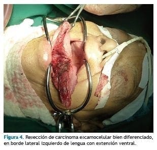 Resección de carcinoma escamocelular