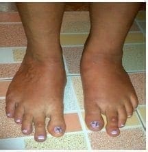 Deformación de los pies con hemaniomas y várices
