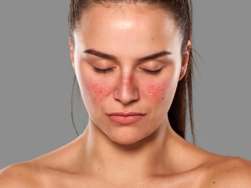 Factores, clínicos, sociodemográficos, inmunológicos y exposicionales en Lupus Eritematoso Sistémico asociados a Nefritis Lúpica en Población Colombiana