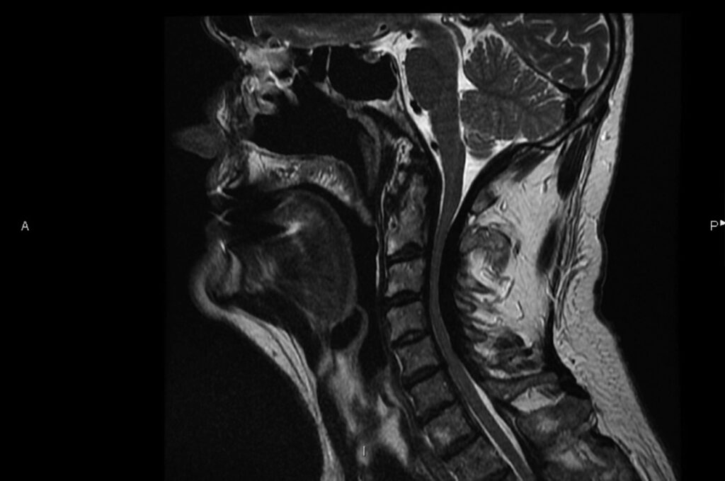 Paquimeningitis Hipertrófica
