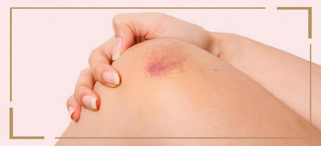 Caracterización Clínica de los Pacientes con Púrpura Trombocitopénica Inmune en un Hospital Universitario en Colombia