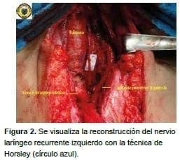 Reconstrucción del nervio laríngeo recurrente