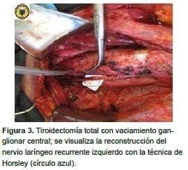 Tiroidectomía total con vaciamiento ganglionar central
