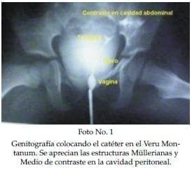 Genitografía colocando el catéter en el Veru Mon­tanum