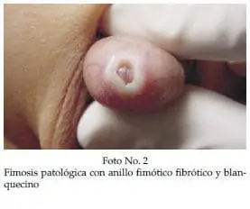 Fimosis patológica con anillo fimótico fibrótico y blan­quecino