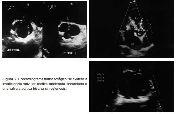 Apendicitis aguda, Ecocardiograma transesofágico