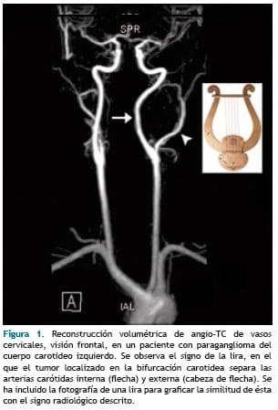 Reconstrucción volumétrica de angio-TC de vasos cervicales