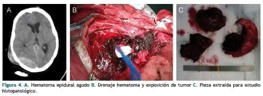Hematoma epidural agudo