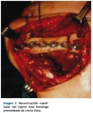 Reconstrucción mandibular con injerto óseo