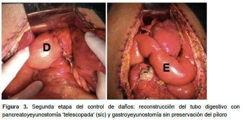 Reconstrucción del tubo digestivo con pancreatoyeyunostomía