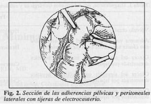 Sección de las adherencias pélvicas y peritoneales
