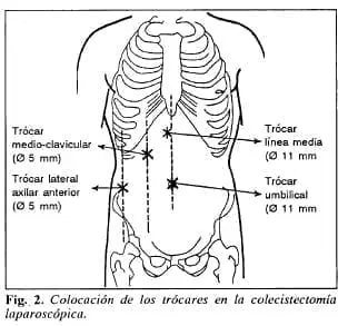 Colocación de los trócares en la colecisleclomía laparoscópica